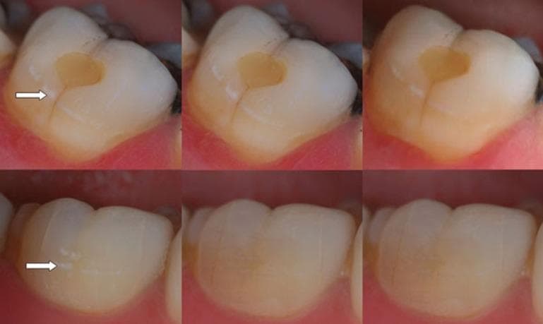 This clinical photographic series displays a temporal progression of Class V dental caries lesions in two different subjects (top and bottom rows) following a single application of P11-4 self-assembling peptide. The images are organized into three time points: baseline (D0), 30-day follow-up (D30), and 180-day follow-up (D180). In the top row (a-c), the baseline image shows a distinct yellowish-brown, oval-shaped carious lesion on the cervical third of the tooth. Over 180 days, the lesion demonstrates a reduction in color intensity and a softening of the margins. In the bottom row (d-f), the baseline lesion (indicated by an arrow) presents as multiple white-spot lesions indicative of early enamel demineralization. By D180, these white spots appear less opaque and more integrated with the surrounding healthy enamel. The sequence illustrates the clinical use of biomimetic mineralization scaffolds to manage early caries, with the primary educational focus being the visual reduction in lesion size and opacity as markers of potential remineralization or stabilization over a six-month period.