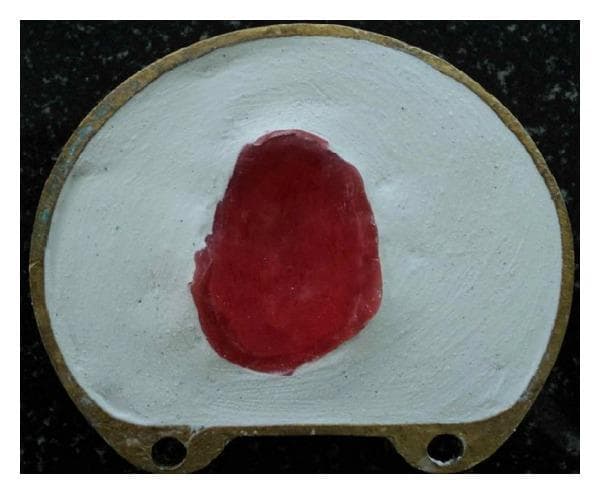 A clinical laboratory photograph showing the flasking stage of a dental obturator prosthesis fabrication. The image depicts a white dental plaster (Type II or III gypsum) cast held within a circular brass or gold-colored dental flask. Centrally, a reddish-pink baseplate wax bulb is adapted into a defect area, representing the 'waxed-up bulb' for a maxillectomy patient. The wax exhibits a smooth, reflective surface and irregular, rounded contours, contrasting with the matte, slightly granular texture of the surrounding dental stone. Two symmetrical orientation holes are visible at the base of the metal flask. This step is critical in the direct investment technique, where the wax pattern is encased in a mold to be later replaced by heat-polymerizing acrylic resin. The educational focus is on the laboratory procedures for fabricating a hollow bulb obturator to rehabilitate speech and mastication in post-surgical maxillary defect cases.