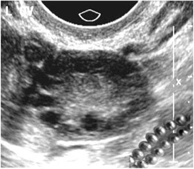 This diagnostic image is an endovaginal ultrasound of a human ovary, commonly associated with the diagnosis of polycystic ovary syndrome (PCOS). The ultrasound shows a transverse cross-section of the ovary characterized by an increased volume and specific follicular distribution. Numerous small, hypoechoic to anechoic cystic structures (follicles), typically measuring 2–8 mm in diameter, are visible. These follicles are arranged in a classic subcapsular distribution, lining up along the periphery of the organ to create the characteristic 'string-of-pearls' sign. The central portion of the ovary consists of a prominent, hyper-echodense ovarian stroma, which appears brighter relative to the dark peripheral cysts. This imaging pattern is a hallmark sonographic criterion for PCOS in the context of clinical signs like hirsutism or metabolic dysfunction. An inset image in the bottom right corner provides a visual analogy using a literal string of pearls to illustrate the diagnostic pattern.
