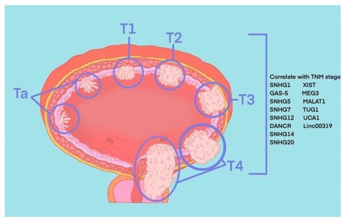 Anatomical diagram of a transverse section of the human urinary bladder illustrating the TNM staging system for bladder cancer (BLCA). The illustration depicts the progression of tumor invasion through the bladder wall layers. Ta stages are shown as small, papillary, finger-like projections confined to the inner urothelium. T1 represents a localized nodular mass invading the lamina propria. T2 shows deeper invasion into the muscularis propria (detrusor muscle). T3 demonstrates extension through the muscle layer into the surrounding perivesical adipose tissue. T4 illustrates advanced invasion into adjacent pelvic organs or the pelvic wall. To the right of the diagram, a list of molecular markers including various Small Nucleolar RNA Host Genes (SNHGs) and long intergenic non-coding RNAs (lincRNAs) such as SNHG1, SNHG14, SNHG20, MALAT1, and Linc00319 are provided, indicating their correlation with these pathological stages. The diagram serves as an educational tool for differentiating non-muscle-invasive bladder cancer (NMIBC) from muscle-invasive bladder cancer (MIBC).