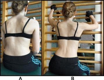 Clinical photograph (posterior view) demonstrating a female patient with scoliosis performing the Schroth '50 x Pezziball' exercise. The image is split into two panels, (a) and (b), illustrating the principle of active 3D auto self-correction. In panel (a), the patient is seated in a neutral, relaxed position on a green Swiss ball (Pezziball) in front of a mirror and wall bar. Visible spinal asymmetry is present, with a right thoracic prominence and left lumbar indentation. In panel (b), the patient performs the corrective exercise by reaching upward and outward to grasp the horizontal rungs of the wall bar. This active engagement facilitates spinal elongation and derotation, aimed at shifting the trunk's convexities inward and expanding the concavities. The patient is wearing athletic attire and gloves for grip. This exercise is a key component of Physiotherapeutic Scoliosis-Specific Exercises (PSSE) designed to stabilize the spine and counter the 'vicious cycle' of curve progression through postural awareness and muscular activation.