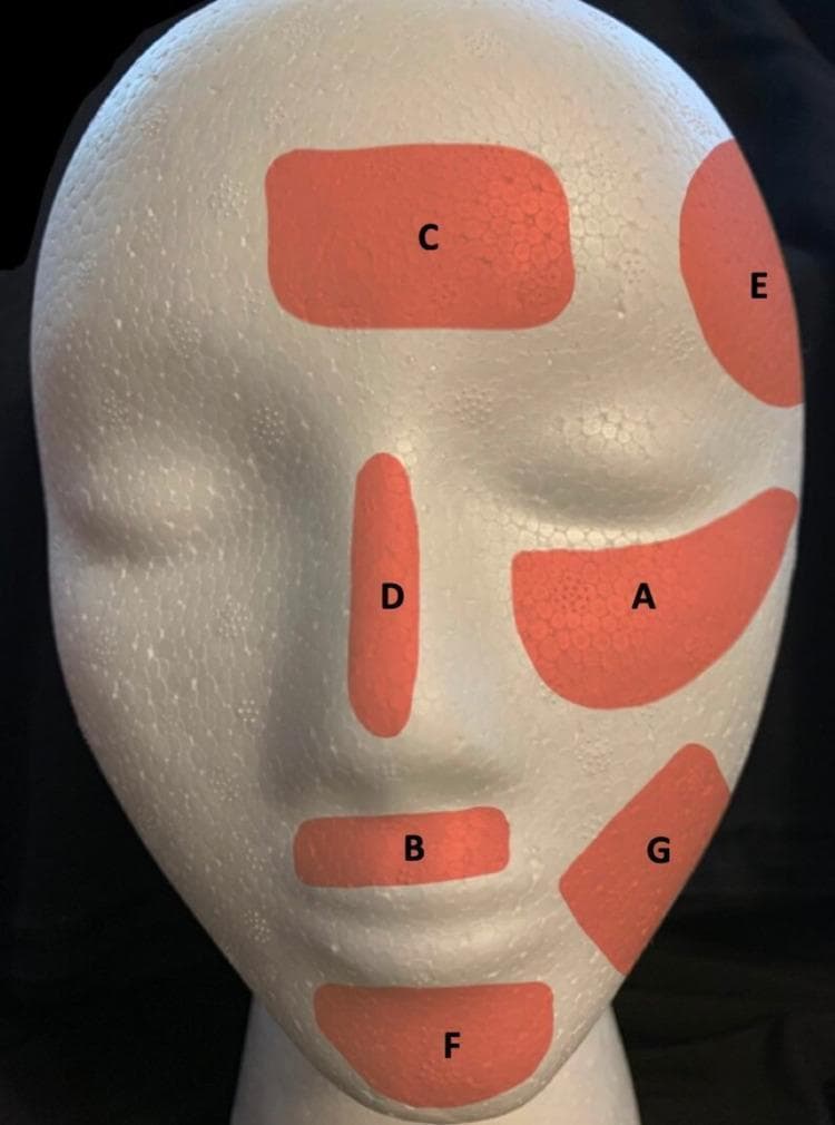 This anatomical diagram uses a white mannequin head to illustrate the most frequent facial regions affected by melasma. Seven orange shaded areas, labeled A through G, represent localized zones of hyperpigmentation based on clinical prevalence. The regions identified include: (A) zygomatic (cheek) area, the most frequent site; (B) supralabial (upper lip) area; (C) frontal (forehead) area; (D) nasal (nose) bridge; (E) temporal area; (F) mental (chin) area; and (G) mandibular (jawline) area. The diagram demonstrates the distribution of centrofacial, malar, and mandibular melasma patterns. These zones correspond to facial convexities most susceptible to ultraviolet (UV) radiation and visible light exposure, which are key triggers for melanocyte activation and exacerbation of melasma. The visual serves as an educational tool for dermatologists and medical students to recognize common clinical presentations and diagnostic patterns of this acquired pigmentary disorder.