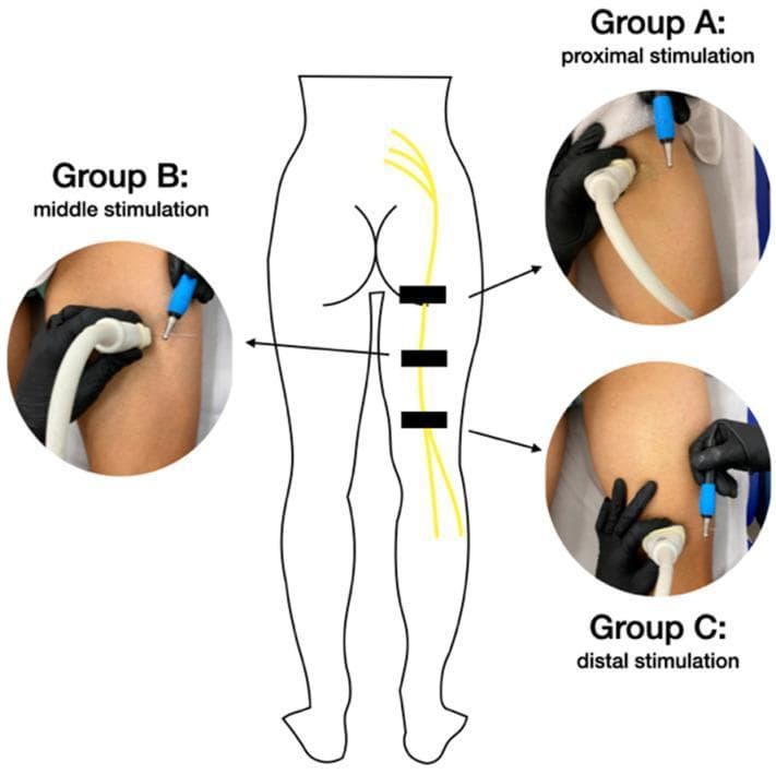 This composite educational image illustrates ultrasound-guided percutaneous neuromodulation of the sciatic nerve. Centrally, a schematic diagram of the posterior human lower body shows the lumbosacral plexus and the vertical descent of the sciatic nerve down the right thigh. Three black rectangular markers indicate the study's target stimulation zones: proximal (Group A), middle (Group B), and distal (Group C). Flanking the diagram are clinical photographs demonstrating the procedural setup for each group. Each photograph shows a clinician's gloved hands performing the technique on a patient in the prone position. A high-frequency linear ultrasound transducer is held in a transverse orientation to locate the sciatic nerve, while an acupuncture needle with a blue-handled applicator is inserted using a long-axis approach to reach the perineurium. The primary educational focus is the anatomical positioning and procedural alignment required for targeted electrical stimulation of the sciatic nerve at varying levels of the posterior thigh for clinical intervention.