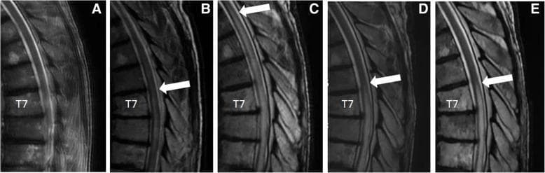 This series of five T2-weighted sagittal MRI images (labeled A through E) illustrates the longitudinal progression and treatment response of transverse myelitis in the thoracic spine. Image A serves as a baseline, showing normal spinal cord signal intensity without lesions. Image B demonstrates the emergence of increased intramedullary T2 signal intensity (hyperintensity) localized near the T7 vertebral level, indicative of early cord changes. Image C reveals significant cephalad extension (ascending) of the lesion, with a white arrow marking the superior border of the transverse myelitis, which now spans multiple vertebral segments. Images D and E show sequential follow-up after the initiation of immunotherapy (infliximab). Image D displays a marked reduction in the longitudinal extent and intensity of the T2 signal abnormality, suggesting a positive therapeutic response. Image E demonstrates a stable but persistent area of mild hyperintensity near T7, reflecting residual cord changes. This radiographic series is a classic educational example of immune-mediated or radiation-induced myelopathy and its monitoring through MRI imaging.