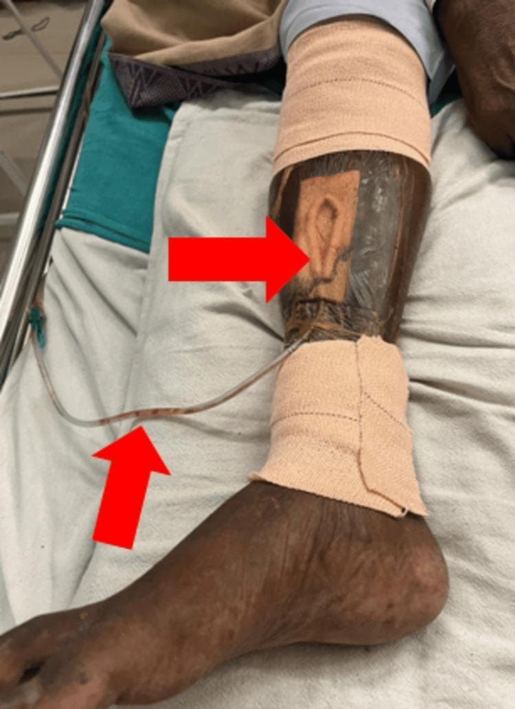 This clinical photograph displays a Vacuum-Assisted Closure (VAC) system applied to a chronic ulcer on the antero-medial aspect of a patient's right lower leg. The visual highlights a multi-component negative pressure wound therapy (NPWT) setup: a porous foam dressing is fitted into the wound bed, sealed under a transparent adhesive drape to maintain an airtight environment. A suction drainage tube, containing serosanguinous fluid, emerges from the inferior aspect of the dressing. The surrounding skin exhibits features consistent with venous insufficiency or chronic stasis, including hyperpigmentation (hemosiderin staining), xerosis, and yellowish discoloration. Compression bandages are applied proximally and distally to the VAC site at the calf and ankle levels. Red arrows indicate the primary wound site under the foam and the drainage tubing. This image serves as a clinical example of advanced wound management for complex lower extremity ulcers, demonstrating the integration of NPWT with standard wound care practices in an elderly patient population.