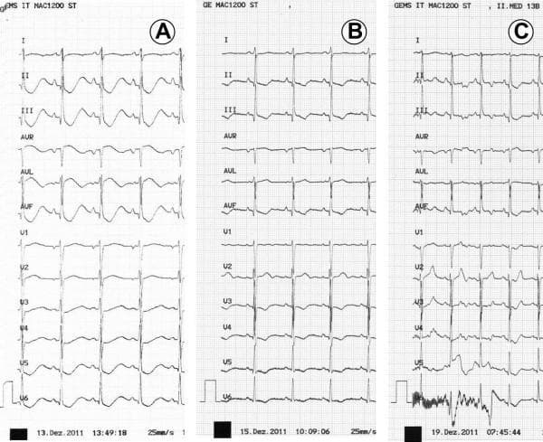A comparison of three sequential 12-lead electrocardiogram (ECG) recordings (A, B, and C) illustrating the progression and resolution of electrolyte-induced cardiac abnormalities. ECG A (Day 1) demonstrates severe abnormalities characteristic of profound hypokalemia, including significant QT interval prolongation (QTc 670 msec), ST-segment depressions in lateral leads, and prominent U-waves merging with T-waves, creating a 'T-U fusion' appearance. ECG B (Day 3) shows partial normalization following electrolyte substitution, with a reduction in QTc to 405 msec and lessening of ST-T wave morphology distortions. ECG C (Day 7) depicts complete resolution, with the ST segments returning to the isoelectric line, normal T-wave morphology, and a stable QTc of 401 msec. The series serves as a clinical illustration of how severe metabolic derangements, such as furosemide-induced hypokalemia, manifest as reversible electrical conduction defects. The image is optimized for teaching cardiac manifestations of electrolyte imbalances and the diagnostic value of serial ECG monitoring in acute care settings.