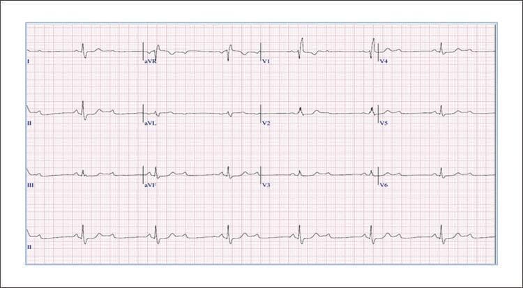 A 12-lead electrocardiogram (ECG) tracing demonstrating a second-degree atrioventricular (AV) block with a 2:1 conduction ratio. The tracing shows two visible P waves for every one QRS complex, where the first P wave is consistently blocked and the second is conducted to the ventricles. The QRS complexes exhibit a widened morphology (>120 ms) with a characteristic Right Bundle Branch Block (RBBB) pattern, evidenced by an rsR' configuration in lead V1 and wide, slurred S waves in leads I, aVL, and V5-V6. Non-specific ST-segment and T-wave abnormalities are present, including mild ST depression and T-wave inversions in the right precordial leads (V1-V3), which are common secondary repolarization changes in the context of RBBB. The tracing represents a clinical case of exercise-induced or recovery-phase infrahisian conduction disease, specifically illustrating the coexistence of bundle branch block and high-grade AV block.
