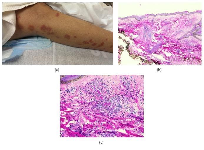 This composite image illustrates the clinical and histopathological findings of drug-induced small vessel vasculitis. Panel (a) is a clinical photograph of a lower extremity showing a multi-focal skin rash characterized by erythematous papules and plaques, some appearing purpuric or urticarial in nature. Panels (b) and (c) present hematoxylin and eosin (H&E) stained sections of a skin punch biopsy at low (20x) and high (200x) magnification, respectively. The histology reveals classic features of leukocytoclastic vasculitis, including a dense perivascular inflammatory infiltrate predominantly composed of neutrophils and eosinophils. Visible vascular damage is evidenced by fibrinoid change and the extravasation of red blood cells into the surrounding dermis. These findings collectively demonstrate a hypersensitivity reaction leading to small vessel inflammation, typical of drug-induced cutaneous vasculitis syndromes such as those triggered by antibiotics.
