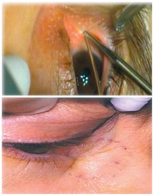 This clinical photograph consists of two panels illustrating steps in an endonasal dacryocystorhinostomy (DCR) procedure. The top panel shows an intraoperative view of the eye where a 20-gauge vitrectomy light probe is being inserted into the superior punctum and upper canaliculus. The probe, a slender metallic instrument with a rounded tip, is directed towards the medial canthal region to reach the lacrimal sac. The lower panel shows a close-up of the periocular region, highlighting the lower eyelid margin and eyelashes. The skin exhibits mild erythema and localized irritation near the medial canthus, consistent with the surgical site or preoperative inflammatory changes. Small, punctate marks are visible on the skin of the lower lid, potentially related to surgical marking or minor trauma. This visual material serves as an educational guide for ophthalmology and otolaryngology students to understand the positioning of transillumination tools used to localize the lacrimal sac during lacrimal bypass surgery.