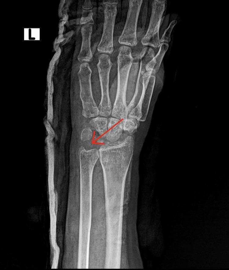 This diagnostic image is a post-operative anteroposterior (AP) view X-ray of the left wrist. The radiograph reveals significant surgical changes, specifically the absence of the proximal row carpal bones (scaphoid, lunate, and triquetrum), consistent with a proximal row carpectomy. A red arrow points to the radiolucent void created by this excision. The distal carpal row remains intact and articulates with the radius. The distal radius and ulna are visualized, as are the metacarpals and phalanges of the hand. Along the lateral aspect of the wrist, a dense, radiopaque, undulating material is visible, which represents post-surgical immobilization—likely a plaster or fiberglass cast or splint. This procedure is frequently performed as a motion-preserving salvage operation for conditions such as advanced Kienbock's disease or scaphoid nonunion advanced collapse (SNAC). The educational focus of the image is the radiological presentation of a partial carpectomy used in orthopedic surgery for chronic wrist pathology.