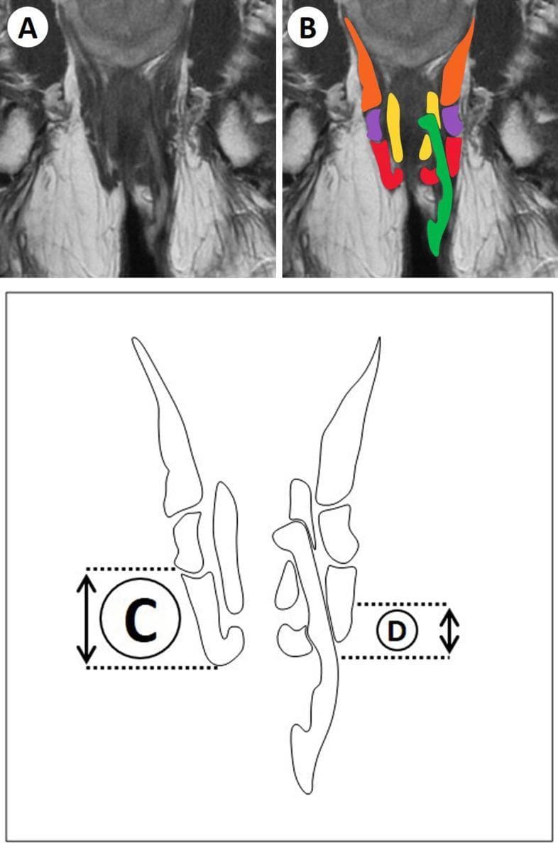 This composite educational image demonstrates the radiological assessment of perianal anatomy and fistula measurement using MRI. Panel A shows an unlabeled coronal T2-weighted MRI sequence of the perianal region. Panel B provides a color-coded anatomical overlay on the same MRI: the fistula tract is highlighted in green, the internal anal sphincter in yellow, the external anal sphincter (EAS) in red, the puborectal muscle in purple, and the levator ani in orange. The bottom schematic diagram (Panels C and D) illustrates the methodology for quantitative measurement. Label C indicates the vertical length or height of the external anal sphincter, while Label D represents the level of fistula penetration, defined as the vertical distance to the most cranial aspect of the tract penetrating the EAS or puborectal muscle. This resource is designed for radiologists and colorectal surgeons to standardize the classification and reporting of complex perianal fistulas.