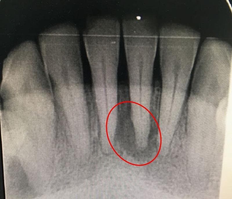 This diagnostic image is a periapical radiograph of the mandibular anterior segment, focusing on the central and lateral incisors. The radiograph demonstrates the dental crowns, roots, and supporting alveolar bone. A significant finding is a well-defined periapical radiolucency (highlighted by a red circle) associated with the apex of the mandibular left central incisor. This area of decreased radiopacity suggests periapical pathology, such as a periapical cyst, granuloma, or abscess. The neighboring teeth show varied morphology, including one tooth with a shorter, wider appearance. The periodontal ligament spaces are visible as thin radiolucent lines surrounding the radiopaque roots. Notable non-carious tooth surface loss is visible on the incisal edges of the crowns. The image serves as a clinical example of endodontic-periodontal assessment, illustrating the radiographic appearance of apical bone resorption in a vital or non-vital tooth scenario within the field of dentistry.