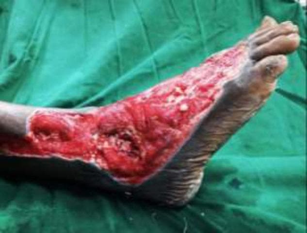 Clinical photograph of a right foot demonstrating a severe, extensive Wagner Grade III or IV diabetic foot ulcer. The wound spans the lateral and dorsal aspects of the foot, extending from the distal lower leg across the ankle joint to the midfoot region. The ulcer bed is characterized by beefy red granulation tissue and deep cavitation, with visible exposure of underlying musculoskeletal structures including the ankle joint. There are focal areas of yellow/white slough and fibrin, indicative of potential infection or chronic inflammatory processes. The wound margins are irregular but well-demarcated against the surrounding hyperpigmented, intact skin. This image serves as a clinical example of complex diabetic wound progression requiring advanced surgical intervention, such as debridement and microvascular flap reconstruction. Key educational concepts include diabetic foot classification, wound bed assessment, and the management of deep tissue infections with joint involvement.