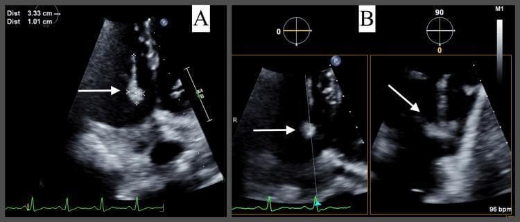 Transthoracic echocardiography (TTE) diagnostic images demonstrating a large, mobile vegetation on the tricuspid valve, characteristic of infective endocarditis. Image A shows a zoomed-in apical four-chamber view where white arrows highlight a hyperechoic mass attached to a tricuspid valve leaflet; on-screen calipers measure the vegetation at 3.33 cm x 1.01 cm. Image B utilizes biplane visualization, presenting simultaneous orthogonal planes to detail the three-dimensional morphology and spatial relationship of the mass within the right heart chambers. The images illustrate key diagnostic criteria for right-sided endocarditis, focusing on mass size, echogenicity, and attachment to valvular structures. This content is relevant for cardiology and infectious disease education, specifically for teaching the echocardiographic identification of major Duke criteria in clinical practice.