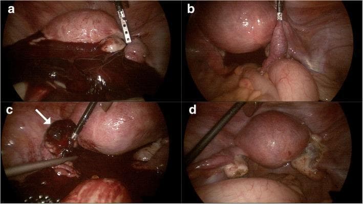 This composite of four laparoscopic images (a-d) illustrates the surgical findings and management of a rare bilateral ectopic pregnancy involving both a tubal and an ovarian implantation. Image (a) shows the initial pelvic cavity inspection, revealing significant hemoperitoneum with dark clotted and fresh blood, indicative of a rupture. Image (b) focuses on the right adnexa, demonstrating an unruptured tubal ectopic pregnancy characterized by a localized distention of the fallopian tube. Image (c) identifies the source of the bleeding: a ruptured ovarian ectopic pregnancy on the left ovary, indicated by a hemorrhagic, dark mass (white arrow) and adjacent hematoma being manipulated with surgical instruments. Image (d) displays the postoperative pelvic cavity following a right salpingectomy and resection of the left ovarian mass, showing a cleared surgical field with visible residual anatomical changes. This case highlights the clinical presentation of hemoperitoneum in gynecological emergencies and the importance of thorough laparoscopic exploration of both adnexa.