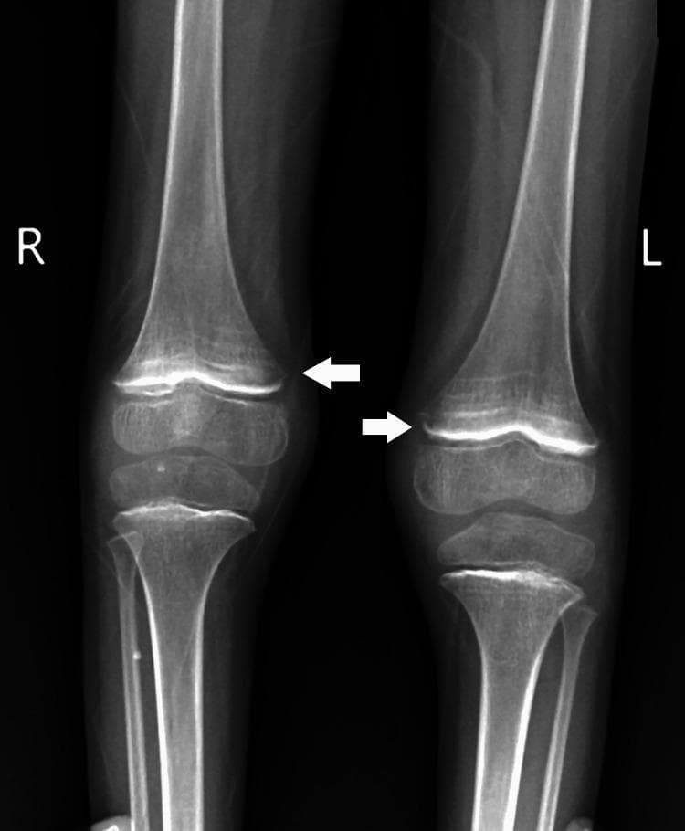 This diagnostic image is an anteroposterior (AP) X-ray of the pediatric lower limbs, specifically focusing on the bilateral knee joints. The radiograph demonstrates findings consistent with scurvy (vitamin C deficiency). Key features include dense, sclerotic bands at the metaphyses, known as the 'white line of Frankel,' and a subjacent radiolucent zone (the 'Trummerfeld zone' or scurvy zone). White arrows indicate bilateral periosteal thinning and elevation, often associated with subperiosteal hemorrhage. The epiphyses show a characteristic 'Wimberger ring sign' with a dense peripheral rim and central lucency. The overall bone density appears slightly decreased, but the architecture of the distal femur, proximal tibia, and fibula remains intact without obvious lytic or sclerotic focal lesions. This visual information is critical for pediatric radiology and nutritional deficiency diagnosis, illustrating musculoskeletal manifestations of scurvy in a growing child.