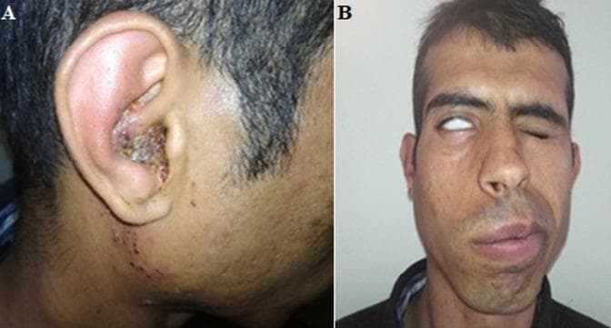 This composite clinical photograph displays the hallmark signs of Ramsay Hunt syndrome (herpes zoster oticus). Image A (left) shows the right ear auricle with inflammatory swelling and a characteristic vesicular eruption within the concha and external auditory meatus. Multiple clustered vesicles and hemorrhagic crusting are visible, extending down the preauricular area and neck. Image B (right) demonstrates an associated ipsilateral peripheral facial nerve palsy (CN VII). Key findings include significant facial asymmetry with right-sided drooping, loss of nasolabial fold depth, and deviation of the mouth to the contralateral (left) side. The patient displays Bell's phenomenon on the right, where the globe rotates upward during an attempt to close the eye, leaving only the white sclera visible due to incomplete eyelid closure (lagophthalmos). These images illustrate the triad of otalgia, auricular vesicles, and facial paralysis typical of varicella-zoster virus reactivation in the geniculate ganglion, targeting medical students and clinicians in neurology, otolaryngology, and dermatology.