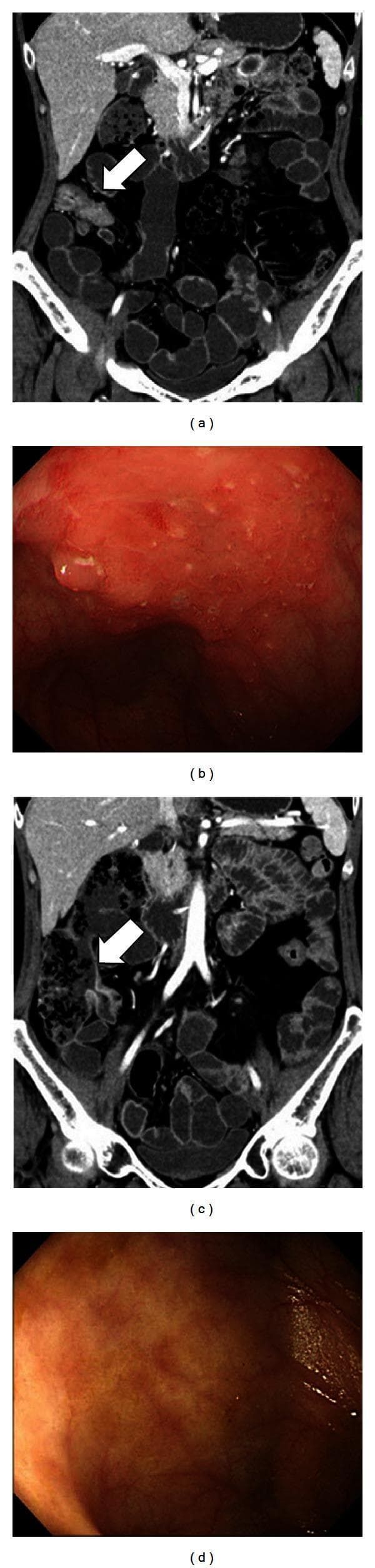 This composite clinical figure illustrates the correlation between diagnostic imaging and endoscopic findings in a patient with Inflammatory Bowel Disease (IBD) before and after biologic therapy. Panels (a) and (c) are coronal CT enteroclysis (CTE) images. Panel (a) displays an active disease state characterized by intestinal wall thickening (arrow) and increased density in the mesenteric fat (fat stranding), indicative of acute inflammation. Panel (c) shows the same region 84 days later, demonstrating therapeutic response with a reduction in wall thickness and normalization of mesenteric fat density. Panels (b) and (d) provide the corresponding endoscopic views of the ileocecal mucosa. Panel (b) reveals severe active inflammation with significant mucosal edema, erythema, and ulcerations. Panel (d) shows post-treatment resolution, featuring a smoother, non-congested mucosal surface without active ulcers or edema. This comparison serves as an educational tool for monitoring treatment efficacy in Crohn's disease using multimodality assessment, highlighting the transition from an active to an inactive inflammatory group.