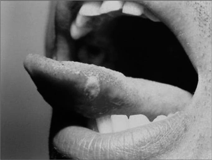 This clinical photograph displays a black-and-white lateral view of a human oral cavity, focusing on a localized lesion on the tongue. A single, discrete ulcer is visible on the lateral border of the tongue. The lesion, identified as aphtha minor, is round-to-oval in shape with well-defined margins. It features a slightly depressed central base and is surrounded by a subtly raised or inflamed border. The ulcer appears relatively small, consistent with minor aphthous stomatitis (typically 3 to 10 millimeters in diameter). Other visible anatomical structures include the upper and lower teeth, the lips, the philtrum, and the inner cheek mucosa. The image serves as a clinical example of Recurrent Aphthous Stomatitis (RAS), specifically the minor type, which characteristically occurs on non-keratinized mobile mucosa such as the lateral tongue. This visual is relevant for medical education in oral pathology, dermatology, and general clinical diagnostics.