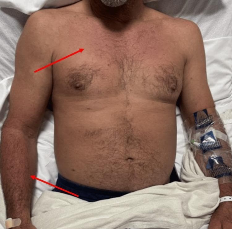 Clinical photograph of a male patient's torso and upper extremities in a hospital setting, illustrating a diffuse, patchy erythematous rash. The skin lesions are most prominent across the upper chest, mid-abdomen, and bilateral arms, with red arrows highlighting the erythematous distribution on the right pectoral region and left forearm. The morphology is consistent with a dissipating maculopapular or morbilliform eruption often seen in systemic viral infections such as Dengue fever. Notable clinical features include the absence of visible scaling and a generalized, non-confluent pattern. On the patient's left forearm, an indwelling intravenous (IV) catheter is secured with a transparent adhesive dressing and tape, and a white hospital identification band is visible on the wrist. This visual evidence supports the clinical assessment of infectious exanthems in the context of systemic illness and thrombocytopenia.