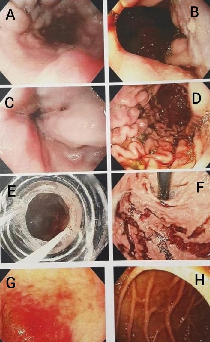 A composite of eight endoscopic images (A-H) illustrating portal hypertension-related pathologies and Upper Gastrointestinal (UGI) endoscopy findings. (A-C) show the progression and severity of esophageal varices; A demonstrates grade 3 varices in the mid-esophagus, while B and C depict high-grade (grade 3-4) varices at the gastroesophageal junction with visible 'red signs' (cherry red spots), indicating a high risk of imminent hemorrhage. (D-F) focus on gastric findings related to variceal bleeding; D shows the gastric body with altered 'old' blood, E provides a view through an endoscopic band ligator during a therapeutic procedure, and F shows clotted blood within the gastric fundus in a retroflexed view. (G-H) represent duodenal involvement, with G showing erythema and mucosal changes characteristic of duodenopathy in the duodenal cap, and H illustrating congested, edematous mucosa in the descending duodenum. This series serves as a clinical reference for diagnosing and managing esophageal varices, portal hypertensive gastropathy, and duodenopathy in the context of acute gastrointestinal bleeding.