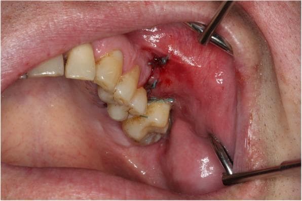 This clinical photograph shows an intraoral view of the upper right posterior quadrant, illustrating the surgical closure of an oroantral communication (OAC) using a Rehrmann flap (buccal advancement flap). The surgical site is located distal to the maxillary premolars and molars. The adjacent gingiva and buccal mucosa exhibit moderate erythema and edema, characteristic of the acute postoperative phase. Blue monofilament sutures are visible, securing the advanced buccal tissue to the palatal margin and interdental areas to achieve primary closure of the defect. A small amount of fresh clotted blood is present along the incision line. Metallic cheek and lip retractors are positioned at the superior and inferior aspects of the oral vestibule to provide optimal clinical visualization. The procedure demonstrates a standard maxillofacial surgical approach to prevent or treat an oroantral fistula by repositioning local soft tissue, which also results in a characteristic reduction of the vestibular height.