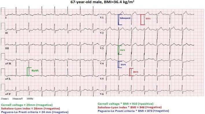 A standard 12-lead electrocardiogram (ECG) from a 67-year-old male with a BMI of 36.4 kg/m², demonstrating voltage criteria for Left Ventricular Hypertrophy (LVH) in the context of obesity. The tracing shows a normal sinus rhythm with a paper speed of 25 mm/s and calibration of 10 mm/mV. Specific voltage measurements are annotated with color-coded brackets to illustrate clinical scoring systems: RaVL (green), SV1 (red), SV3 (green), SV4 (blue), Sdeepest (blue), and RV5 (red). The limb leads (I, II, III, aVR, aVL, aVF) show a normal QRS axis. Precordial leads (V1-V6) display a normal R-wave progression from V1 to V5. Textual annotations below the ECG evaluate multiple LVH criteria, highlighting that while the standard Cornell voltage (RaVL + SV3 = 25 mm), Sokolow-Lyon index (26 mm), and Peguero-Lo Presti criteria (24 mm) are individually negative, the BMI-adjusted Cornell voltage ((RaVL + SV3) * BMI = 910) is positive. This visual serves as an educational tool for diagnostic cardiology, emphasizing the necessity of BMI adjustment when assessing LVH in obese patients.