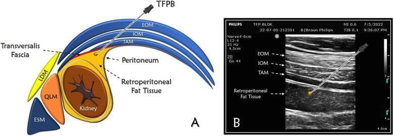 This dual-panel medical figure illustrates the Transversalis Fascia Plane Block (TFPB) through an anatomical diagram and a corresponding ultrasound image. Panel A is a cross-sectional anatomical diagram depicting the abdominal wall and retroperitoneal space. It identifies the three lateral abdominal muscle layers: external oblique (EOM), internal oblique (IOM), and transversus abdominis (TAM). Posteriorly, the latissimus dorsi (LDM), quadratus lumborum (QLM), and erector spinae (ESM) muscles are shown. The needle trajectory is illustrated passing through the three abdominal muscles to reach the target plane between the transversalis fascia and the retroperitoneal fat tissue overlying the kidney and peritoneum. Panel B is a high-frequency linear ultrasound scan demonstrating the clinical application. The ultrasound shows the characteristic stratified appearance of the EOM, IOM, and TAM as hypoechoic bands separated by hyperechoic fascial planes. An echogenic needle is visualized using an in-plane technique, with its tip positioned in the hypoechoic retroperitoneal fat layer deep to the TAM. This visual educational resource is designed for anesthesia and pain management training, focusing on regional nerve block landmarks and ultrasound-guided needle placement.