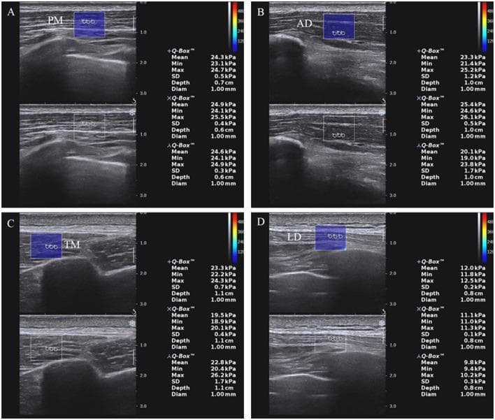 This diagnostic image set consists of four panels (A–D) demonstrating Shear Wave Elastography (SWE) of shoulder internal rotation muscles in a clinical setting, specifically related to Hemiplegic Shoulder Pain (HSP). The imaging modality combines B-mode grayscale ultrasound with color-coded elastography to assess tissue stiffness. The panels depict the pectoralis major (PM) in A, anterior deltoid (AD) in B, teres major (TM) in C, and latissimus dorsi (LD) in D. Each panel features a split-screen view: the top showing a blue rectangular elastic sampling frame overlaid on the muscle, and the bottom showing the corresponding B-mode reference. Within the sampling frames, three circular regions of interest (ROIs) are labeled. To the right of each image, quantitative data boxes (+Q-Box, XQ-Box, AQ-Box) provide mean, minimum, maximum, and standard deviation of stiffness values in kilopascals (kPa), alongside depth and diameter measurements. A vertical color bar indicates the elasticity scale. This diagnostic tool is used to quantify muscle hypertonia and stiffness at rest to evaluate pathological changes in musculoskeletal conditions.