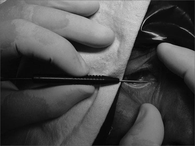 This monochrome intraoperative clinical photograph demonstrates the insertion of a thin metallic optic fiber into the inferior lacrimal canaliculus of a patient. The procedure is part of a dacryocystorhinostomy (DCR) or similar nasolacrimal duct intervention where transillumination is required. A medical professional, wearing sterile surgical gloves, is seen manipulating the instrument. The optic fiber is attached to a black cylindrical handle with textured grip markings for precise control. The fiber enters through the lacrimal punctum of the lower eyelid, following the anatomical path of the canaliculus toward the lacrimal sac. Visible anatomical landmarks include the lower eyelid margin, periorbital skin folds, and the medial canthal region. The surgical field is partially draped with a sterile cloth, focusing the view on the lacrimal drainage system. This image serves as an educational guide for ophthalmology and otolaryngology trainees on the technique of canalicular probing and the use of transillumination to identify the lacrimal fossa from a nasal perspective.