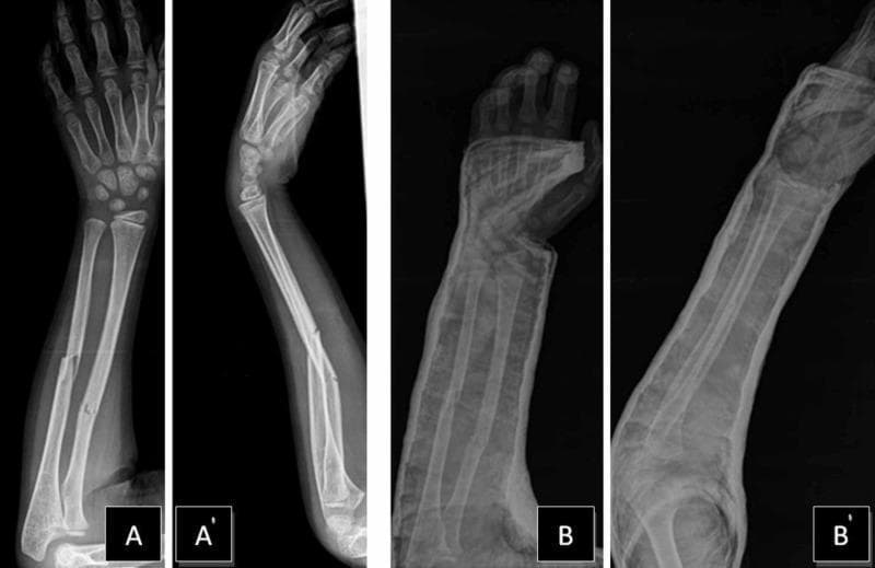 Diagnostic X-ray series of a pediatric patient's right forearm demonstrating a mid-shaft 'both-bone' fracture and subsequent management. Panels A (Anterior-Posterior) and A' (Lateral) show a complete, transverse to short-oblique fracture of the middle diaphysis of both the radius and ulna. The fracture displays significant lateral and dorsal displacement with associated angulation of the distal bone fragments. Panels B (AP) and B' (Lateral) depict the forearm following closed reduction and stabilization in a radiopaque long-arm cast. In these post-reduction views, the alignment of the radial and ulnar shafts is markedly improved, showing successful restoration of bone apposition and reduction of the initial angulation. Key educational landmarks include the open physes (growth plates) characteristic of a pediatric skeletal age and the clinical demonstration of non-operative orthopedic management of common diaphyseal forearm fractures through closed reduction and casting.
