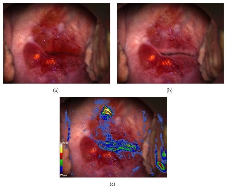 This set of clinical photographs illustrates a gynecological colposcopy examination for cervical cancer screening. Image (a) shows the native cervix prior to acetic acid application, revealing a reddish, smooth surface with Nabothian cysts visible at the 6 and 8 o’clock positions. Image (b) shows the same anatomical region 30 seconds after the application of 3% acetic acid; it demonstrates a minimal, subtle acetowhitening reaction near the external os, which might be missed on conventional visual inspection. Image (c) presents a Dynamic Spectral Imaging (DSI) color-coded map overlaid on the colposcopic view. The DSI scale (ranging from blue for weak to red/yellow for strong) identifies a focal area of persistent, intense acetowhitening at the 11-12 o'clock position. This digital mapping provides an objective assessment of tissue kinetics, highlighting a high-risk lesion that was histologically confirmed as invasive squamous cell carcinoma. This comparison demonstrates the clinical utility of adjunctive digital imaging in identifying neoplastic lesions that lack distinctive classic colposcopic features.