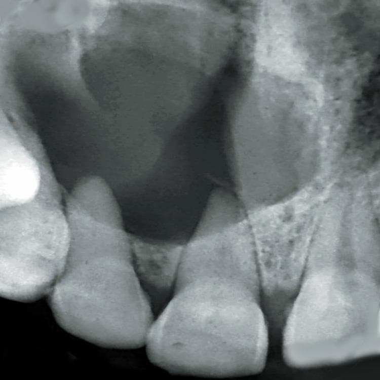 This diagnostic image is an intraoral periapical radiograph of the maxillary anterior region, specifically focusing on teeth 11, 12, and 13. The radiograph reveals a large, well-defined, and corticated radiolucency extending from the periapical region of the right maxillary central incisor (tooth 11) laterally toward the canine (tooth 13). Key pathological features include significant root resorption and a wide, blunted apex of tooth 11, which is the likely tooth of origin. Additionally, there is a distal displacement of the root of tooth 12, indicating the pressure effects of the expanding lesion. The lesion's well-circumscribed, radio-opaque border suggests a slow-growing, benign cystic process, characteristic of a radicular (periapical) cyst. This radiographic presentation is essential for distinguishing between periapical granulomas, cysts, and other odontogenic lesions such as odontogenic keratocysts or ameloblastomas. The image serves as a clinical example of the secondary effects of chronic periapical inflammation on adjacent dental and bony structures.