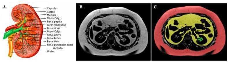 This composite educational image illustrates renal anatomy and abdominal fat segmentation. Panel A is an anatomical diagram of a human kidney in cross-section, detailing the outer renal capsule, cortex, and inner medulla containing renal pyramids and papillae. The collecting system is shown with minor and major calyces, the renal pelvis, and the ureter, alongside the renal artery and vein. Panels B and C demonstrate diagnostic imaging of the abdomen. Panel B is a transverse MRI slice at the level of the kidneys showing standard grayscale tissue contrast. Panel C displays the same MRI slice with manual color-coded segmentation for body composition analysis: red highlights subcutaneous adipose tissue (SAT), yellow denotes visceral adipose tissue (VAT), and green identifies renal sinus fat (RSF) localized within the medial aspect of the kidney. This visual comparison integrates gross anatomy with clinical imaging techniques used to quantify ectopic fat depots and their metabolic implications.