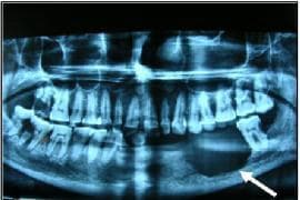 This diagnostic image is an Orthopantomogram (OPG), a panoramic dental X-ray, demonstrating a large pathological lesion in the mandible. The primary finding is a well-defined yet irregular radiolucent lesion located within the left mandibular body, indicated by a white arrow. The lesion exhibits significant osteolytic activity, resulting in the destruction of the surrounding medullary and cortical bone. The adjacent dentition shows clinical complications, including missing teeth in the left mandibular quadrant and evidence of dental caries in the remaining teeth bordering the mass. The radiographic appearance of the radiolucent area, combined with the irregular margins and localized bone destruction, is suggestive of an odontogenic tumor or carcinoma, such as clear cell odontogenic carcinoma or ameloblastoma. This image is used in dental and maxillofacial education to illustrate the radiographic presentation of aggressive mandibular neoplasms and the importance of panoramic imaging in identifying bone-destroying lesions of the jaw.