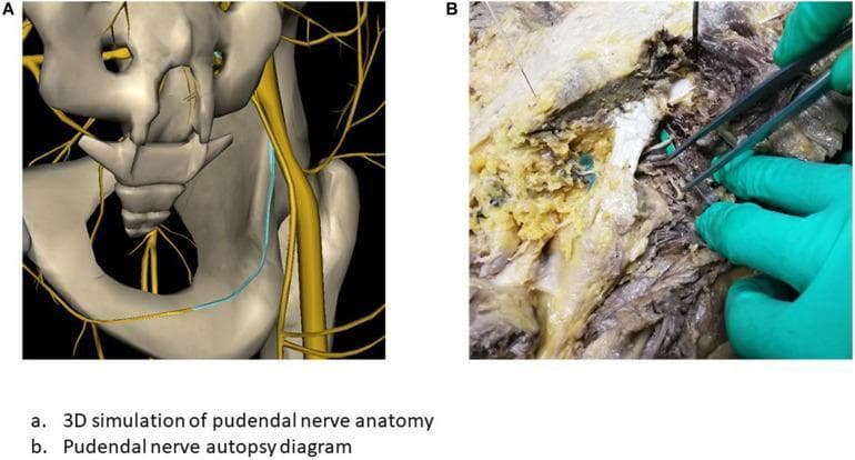 Educational comparison illustrating the anatomical localization of the pudendal nerve through two modalities: a 3D simulation (A) and a cadaveric autopsy dissection (B).
Panel A presents an anatomical diagram using 3D bone reconstruction (gray-beige) of the pelvis, including the sacrum, ilium, and ischial spine. The pudendal nerve and its branching sacral plexus (S2–S4) are rendered in yellow. A light blue trace highlights the specific surgical path of the nerve as it travels through the greater sciatic foramen and along the inner aspect of the ischium toward the pudendal canal.
Panel B shows a clinical photograph of a cadaveric dissection in the gluteal/perineal region. The image depicts the preserved anatomical tissues, showing muscular layers, yellowish adipose tissue, and connective fascia. A gloved hand uses metallic surgical forceps to isolate and demonstrate the physical path of the pudendal nerve among surrounding neurovascular structures.
This comparison serves to correlate theoretical 3D digital mapping with real-world gross anatomy, specifically for planning surgical procedures such as pudendal nerve blocks or the implantation of neuromodulation electrodes.