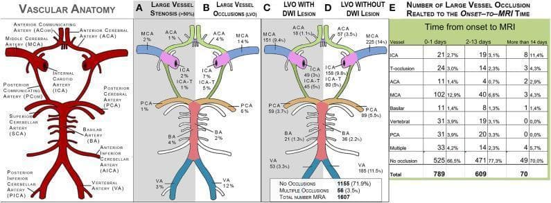 This composite educational graphic depicts intracranial vascular anatomy and the distribution of cerebrovascular pathology. On the far left, a labeled anatomical diagram of the Circle of Willis identifies major arteries: Internal Carotid (ICA), Middle Cerebral (MCA), Anterior Cerebral (ACA), Posterior Cerebral (PCA), Basilar (BA), and Vertebral (VA) arteries. Panels A-D use simplified vascular maps to show frequency data (N=1,597): (A) Large Vessel Stenosis (>50%), (B) Large Vessel Occlusions (LVO), (C) LVO with corresponding Diffusion-Weighted Imaging (DWI) lesions, and (D) LVO without corresponding DWI lesions. The data indicates higher rates of occlusion in the MCA (14%) and VA (12%) compared to stenosis rates. Panels C and D further differentiate clinical presentations by correlating MRA findings with ischemic tissue changes on MRI. Panel E is a data table summarizing the frequency and percentage of specific LVOs categorized by the time interval from stroke onset to MRI (0-1 days, 2-13 days, and >14 days). This resource is designed for neurology and radiology students to understand the epidemiological distribution of ischemic stroke mechanisms.