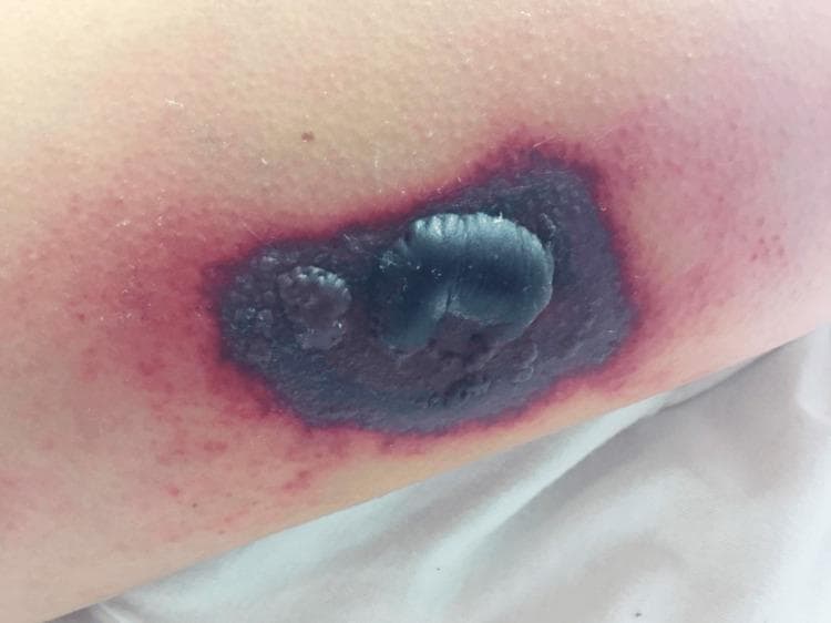 This clinical photograph displays a focal, necrotic skin lesion on an extremity. The lesion is characterized by a central, tense, dark-purple-to-black bulla (blister) approximately 2–3 cm in diameter, indicating epidermal detachment and underlying tissue necrosis or hemorrhage. Surrounding this central bulla is a well-demarcated area of deep violaceous or purpuric plaque. A prominent outer erythematous halo is visible, suggesting secondary acute inflammation. The morphology is consistent with ecthyma gangrenosum, vasculitis, or a progressive cutaneous manifestation of systemic illness such as T-cell lymphoma or leukemia cutis. This visual provides high-yield educational value for identifying necrotic bullae and understanding the progression from livedo reticularis to necrotic plaque and ulceration in a clinical dermatology or oncology context.