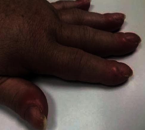 This clinical photograph shows a close-up view of a human hand demonstrating classic digital clubbing (Hippocratic fingers). The distal phalanges of the thumb and fingers are visibly bulbous and enlarged, losing their normal distal tapering. Key morphological features include a distinct convexity of the fingernails and an increased Lovibond angle (the angle between the nail plate and the proximal nail fold). The surrounding soft tissue appears edematous and erythematous, particularly around the nail beds, which exhibit a characteristic shiny, thickened skin texture. This finding is a critical clinical sign often associated with chronic hypoxemia, underlying pulmonary or cardiovascular disease, or as a component of hypertrophic osteoarthropathy in the context of malignancy. The image serves as a high-fidelity visual reference for medical students and clinicians for identifying systemic manifestations of internal pathology during a physical examination.