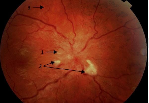 This clinical photograph displays a retinal fundus image highlighting hypertension-mediated end-organ damage (EOD), specifically hypertensive retinopathy. The image is annotated with numerical markers indicating key diagnostic features: (1) points to blurred optic disc margins and papilloedema, signaling severe intracranial pressure or grade IV hypertensive changes; (2) identifies multiple cotton wool spots, which are small, fluffy, whitish lesions representing focal retinal ischemia; and (3) demonstrates generalized arteriolar attenuation and increased vascular tortuosity, where the retinal vessels appear narrowed and more winding than normal. The anatomical focus includes the optic nerve head, the retinal nerve fiber layer, and the retinal vasculature. This material is pedagogically relevant for ophthalmology and internal medicine, illustrating the ocular manifestations of malignant or accelerated hypertension and the importance of fundoscopic examination in assessing systemic cardiovascular risk and subclinical target organ damage.
