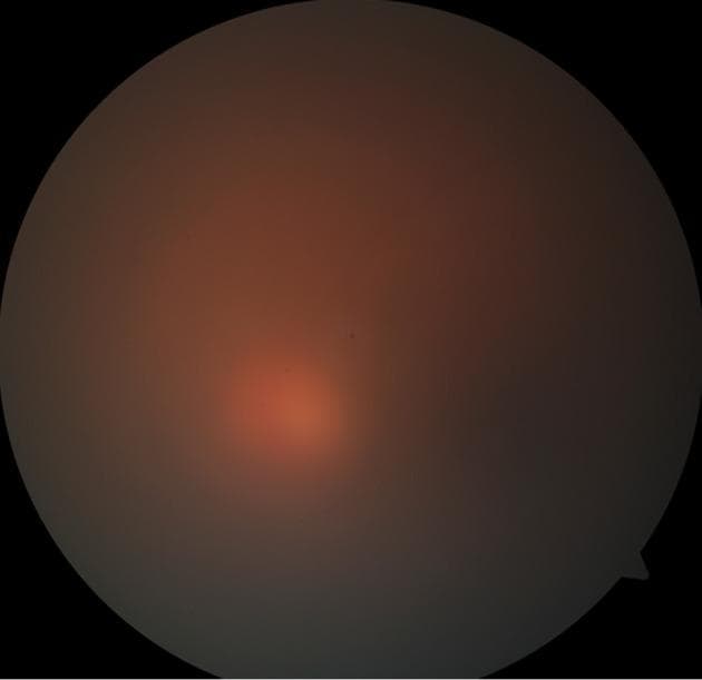 This diagnostic clinical photograph displays a fundus view of the human eye, characterized by extreme vitreous haze (Grade 4+) and reduced media clarity. The image demonstrates the classic presentation of endophthalmitis, where internal ocular inflammation severely obscures retinal landmarks. The optic disc, macula, and retinal vasculature are clinically invisible due to the dense, diffuse opacification of the vitreous humor. Scattered throughout the hazy medium are subtle, non-discrete vitreous exudates, appearing as irregular opacities that further degrade the image quality. This visual finding is a critical sign of intraocular infection or severe inflammation, often associated with a precipitous drop in visual acuity. The diagnostic image serves to illustrate the physical limitations of fundus examination in the presence of advanced vitritis, necessitating alternative diagnostic modalities like B-scan ultrasonography for assessing retinal attachment.