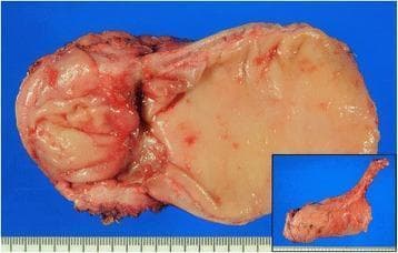 This clinical photograph shows a gross pathological specimen of a total mesorectal excision (TME) following neoadjuvant chemoradiotherapy for rectal cancer. The mucosal surface is displayed against a blue background, featuring a prominent, centrally located depressed scar where the primary bulky tumor previously resided. The scar tissue appears pale, smooth, and contracted, indicative of a significant therapeutic response (downsizing/downstaging). Surrounding the scar, the mucosal folds and mesorectal fat show variations in color from pale yellow to reddish-pink, with some areas appearing irregular or thickened. A small inset image in the bottom right corner provides a macroscopic view of the intact resected segment, showing the fleshy, reddish-pink external surface and elongated morphology of the distal rectum. A metric ruler is visible at the bottom for scale. This image illustrates the gross morphological changes associated with successful preoperative treatment in colorectal oncology.
