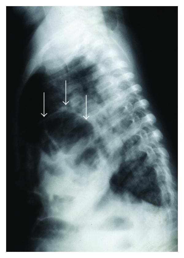 This lateral pediatric chest X-ray demonstrates a large diaphragmatic defect with significant herniation of abdominal contents into the thoracic cavity. The image shows multiple rounded and irregularly shaped areas of increased lucency (air-filled spaces) extending superiorly from the abdominal region into the posterior and lower chest, as indicated by three white arrows. These findings are characteristic of bowel loops within the thorax. The vertebral column and rib cage appear anatomically intact, though the normal lung parenchyma is displaced and obscured in the lower half of the chest due to the presence of these radiolucent structures. This diagnostic imaging is consistent with a congenital or acquired diaphragmatic hernia, such as a large paraesophageal hernia, leading to intrathoracic bowel displacement. Clinical relevance includes the potential for respiratory distress, failure to thrive, and gastric volvulus. The educational focus is on identifying abnormal air-filled visceral structures within the mediastinum and pleural space on pediatric radiology.