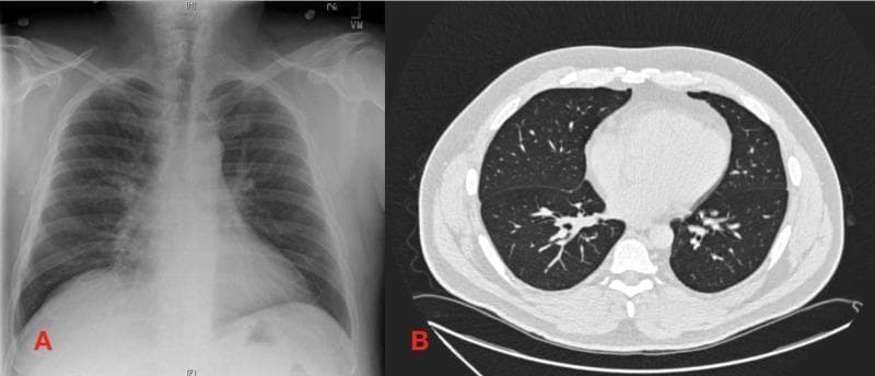 A comparative clinical imaging set featuring a chest X-ray and a computed tomography (CT) scan illustrating the resolution of pulmonary pathology. Panel A shows a posterior-anterior chest X-ray on the day of discharge, revealing a mild, hazy opacity in the right middle lobe, consistent with residual pneumonitis or infiltrate. The rest of the lung fields show improved aeration compared to previous acute states. Panel B displays a follow-up axial chest CT (lung window) taken six weeks later. The CT demonstrates a complete resolution of previous bilateral ground-glass and nodular opacifications. The lung parenchyma appears clear bilaterally with no evidence of residual scarring, fibrosis, or architectural distortion. This comparison illustrates the typical radiological progression and clearance of inflammatory or infectious lung diseases, such as Mycobacterium avium complex (MAC) pneumonitis or hypersensitivity pneumonitis, following appropriate treatment and steroid therapy.