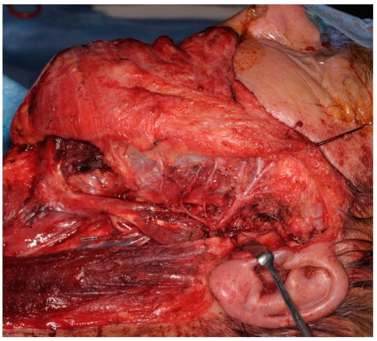 This clinical intra-operative photograph displays a large-scale dissection of the parotid and facial region during a total parotidectomy. The surgical field reveals an anatomical display of the facial nerve (Cranial Nerve VII) and its distal branching network preserved and traversing the surgical void created by the resection of the parotid gland. Key structures visible include the masseter muscle superiorly, the sternocleidomastoid muscle at the inferior margin, and the external ear at the lower right, where a surgical retractor is positioned for tissue displacement. Multiple fine nerve branches are seen branching across the exposed muscle bed and subcutaneous fat. The image demonstrates a 'Type 0 defect,' characterized by an intact facial nerve following tumor resection. This visual serves to educate on the intricate neurovascular anatomy of the head and neck, specifically highlighting surgical landmarks necessary for nerve preservation during oncological resections in otorhinolaryngology and maxillofacial surgery.