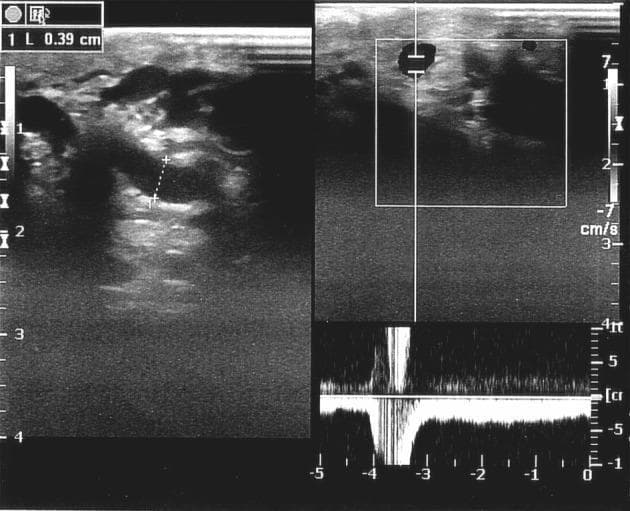This diagnostic ultrasound image demonstrates a Color Doppler Sonography (CDS) study of the scrotum in a patient with clinical varicocele. The left panel shows a B-mode grayscale image of the pampiniform plexus, revealing multiple dilated, anechoic tubular structures consistent with enlarged testicular veins. Calipers measure a vein diameter of 0.39 cm (3.9 mm), which exceeds the typical upper threshold for normal testicular vein size. The right panels display Duplex mode imaging combining real-time B-mode with spectral Doppler analysis. The spectral waveform at the bottom illustrates the hemodynamic response to a Valsalva maneuver. A significant negative deflection below the baseline is visible, representing retrograde flow (venous reflux) with a duration exceeding 2 seconds. The velocity scale ranges from approximately -7 to 7 cm/s. This combination of venous dilation and Valsalva-induced reflux flow is characteristic of grade III varicocele and is used preoperatively to assess venous insufficiency and the severity of the condition within the field of urology and radiology.