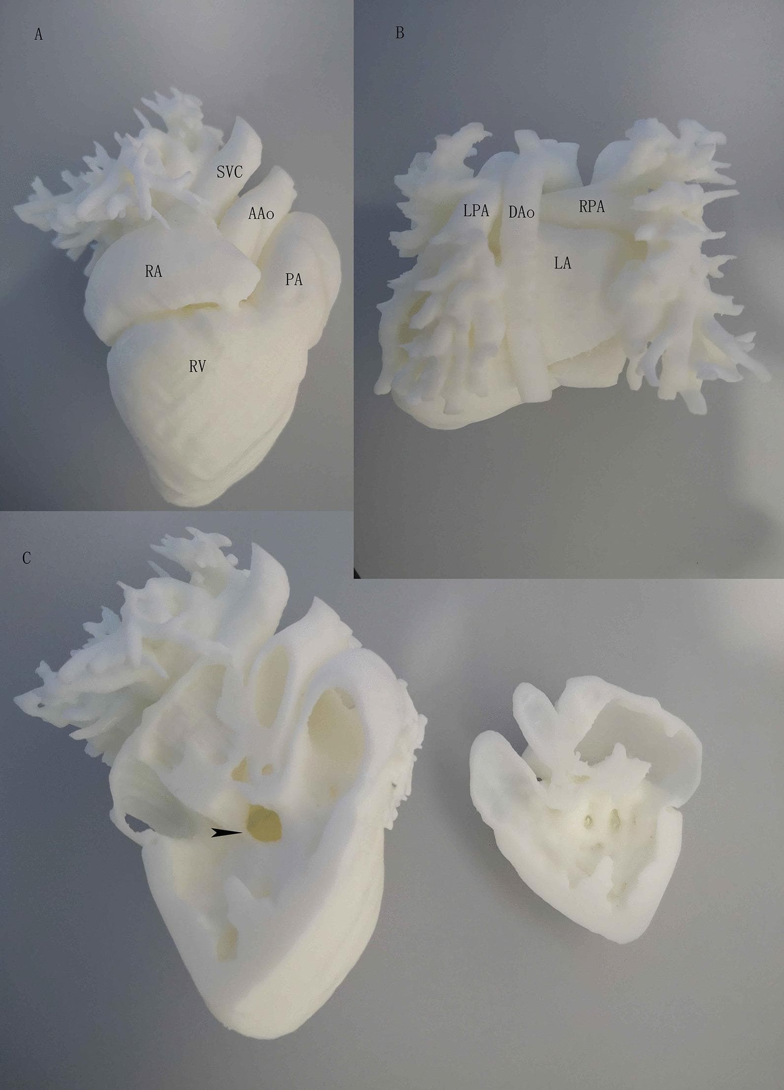 This composite educational image features a high-fidelity, white 3D-printed heart model used for clinical demonstration and surgical planning.
Figure A (Front View): Highlights the anterior cardiac anatomy, including the right atrium (RA), right ventricle (RV), ascending aorta (AAo), superior vena cava (SVC), and pulmonary artery (PA). The spatial orientation shows the SVC entering the RA superiorly and the AAo originating from the base of the heart adjacent to the PA.
Figure B (Back View): Provides a posterior perspective identifying the left atrium (LA), descending aorta (DAo), and the branching of the pulmonary arteries (LPA and RPA).
Figure C (Inside View): Displays a coronal cross-section through the right ventricle, revealing the internal septal anatomy. An arrowhead points to a perimembranous ventricular septal defect (VSD), visualized as a distinct opening in the superior portion of the interventricular septum that allows communication between the ventricles.
The model serves as a pedagogical tool for congenital heart disease education, specifically illustrating a large VSD and its relationship to major great vessels.