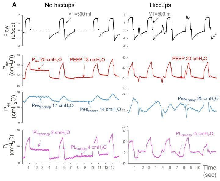 A multi-panel medical diagnostic graphic displaying mechanical ventilation waveforms over time (seconds) in a patient with volume-controlled ventilation (VCV). The image compares two clinical states: 'No hiccups' (left) and 'Hiccups' (right). Four synchronous traces are shown: Flow (L/sec), Airway Pressure (Paw, cmH2O), Esophageal Pressure (Pes, cmH2O), and Transpulmonary Pressure (PL, cmH2O). In the 'No hiccups' state, waveforms show regular patterns with a Paw of 25 cmH2O, PEEP of 18 cmH2O, and positive PL values (PLendinsp 8 cmH2O, PLendexp 4 cmH2O). In the 'Hiccups' state, following an increase in PEEP to 20 cmH2O, the waveforms exhibit significant patient-ventilator asynchrony. Notable features include erratic Pes fluctuations (Pesendexp 25 cmH2O) and sharp, irregular spikes in flow and airway pressure. Critically, the 'Hiccups' panel demonstrates a negative end-expiratory transpulmonary pressure (PLendexp -5 cmH2O), illustrating the physiological impact of involuntary diaphragmatic contractions on lung recruitment and ventilation stability.