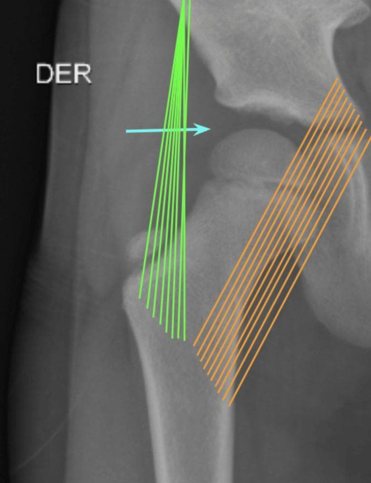 This diagnostic radiograph (X-ray) shows an anteroposterior (AP) view of a pediatric right hip joint, specifically focused on the coxofemoral articulation. The image features overlaid schematics illustrating the procedural approach for an anterolateral arthrocentesis. Key anatomical structures visible include the femoral head, femoral neck, greater trochanter, and the acetabulum of the pelvis. Colored annotations are used to demonstrate ligamentous anatomy and procedural navigation: fanned green lines represent the iliofemoral ligament located laterally, and parallel orange lines represent the pubofemoral ligament located medially. A horizontal blue arrow indicates the needle insertion trajectory and entry point into the joint space, which has been widened through articular traction in a dorsal recumbent position. This visual aid serves as a clinical guide for orthopedic residents and medical students to understand the anatomical landmarks and biomechanical considerations during therapeutic and diagnostic joint aspiration or injection procedures.