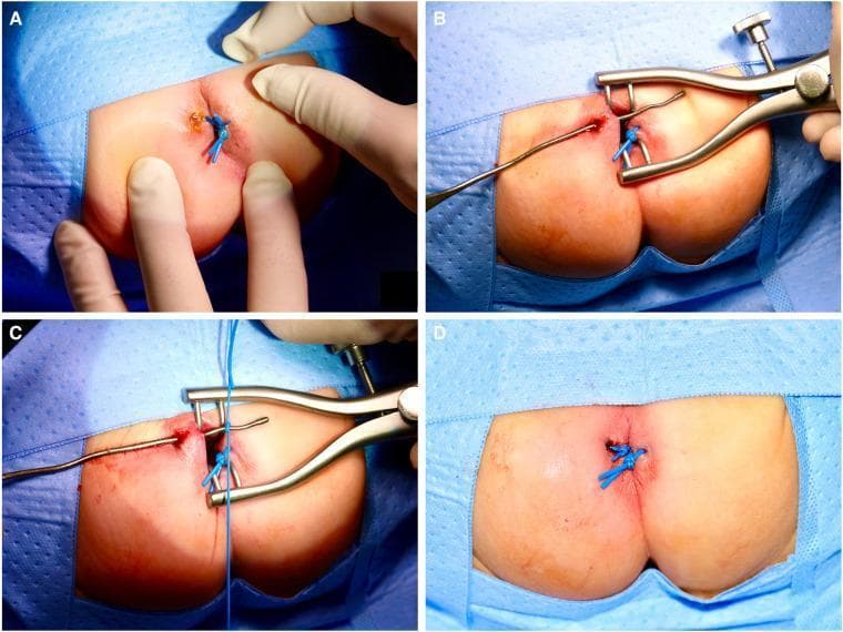 A series of four clinical photographs (A–D) illustrating a sphincter-sparing surgical technique for treating fistula-in-ano (FIA) in a pediatric patient. Panel A: Initial clinical presentation of a perianal abscess and fistula opening at the 10 o’clock position, with a previously placed blue silicone seton already visible at the 3 o’clock position. Panel B: Identification and exploration of the fistulous tract using a metal bulb-headed lacrimal probe while a surgical retractor provides exposure of the anal verge. Panel C: Placement of a new silicone vessel loop (seton) by attaching it to the tip of the lacrimal probe to be pulled through the tract. Panel D: Post-procedural view showing the silicone vessel loop ligated loosely outside the anus. This procedure demonstrates a non-cutting seton placement aimed at promoting drainage and controlled fibrosis while avoiding damage to the anal sphincter, particularly relevant in neonatal and infant proctology.